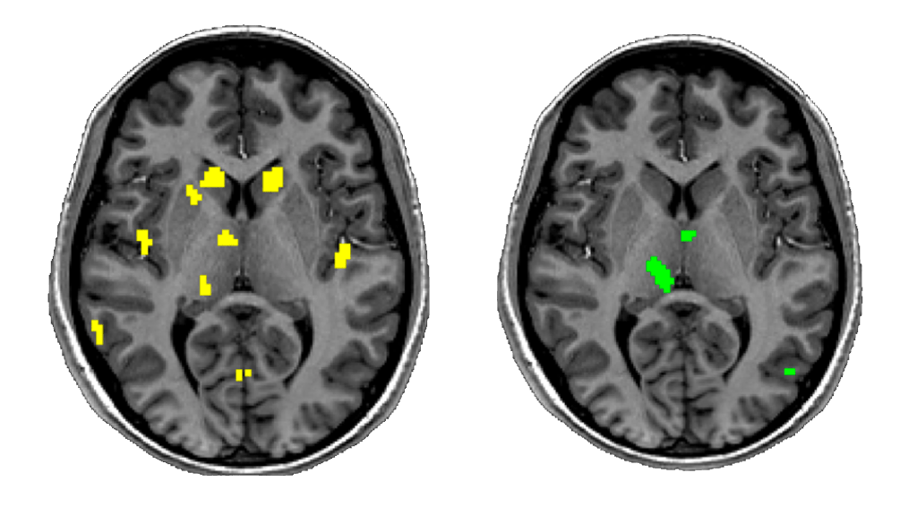 Larger brain activity on the left and smaller brain activity on the right